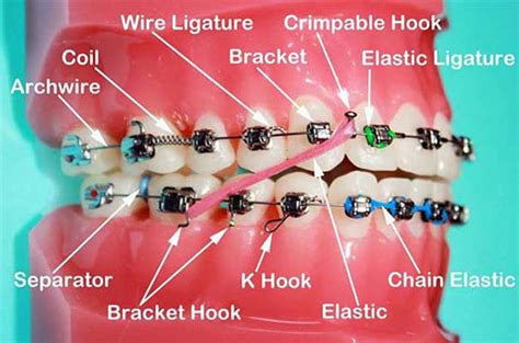 doe all metal braces brackets need wire|closing wire for braces.